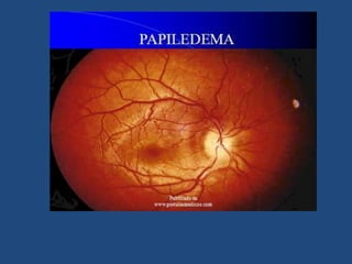 Hypertensive heart failure