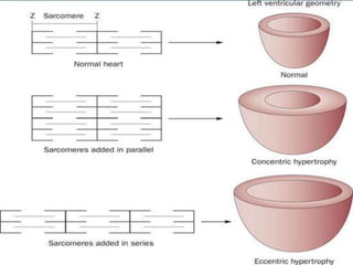 Hypertensive heart failure