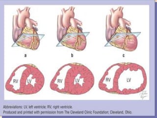 Hypertensive heart failure