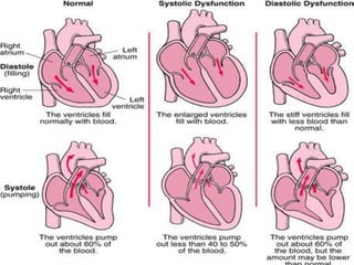 Hypertensive heart failure