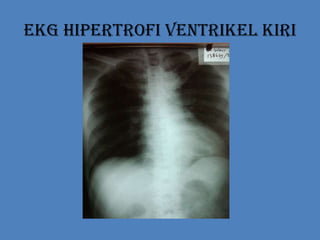 EKG Hipertrofi Ventrikel Kiri
 
