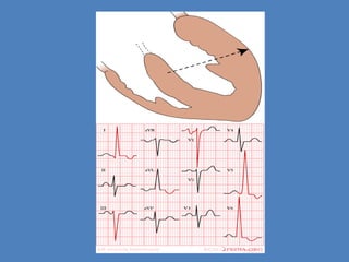 Hypertensive heart failure