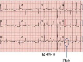 Hypertensive heart failure