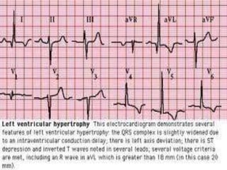 Hypertensive heart failure