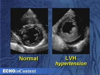 Hypertensive heart failure