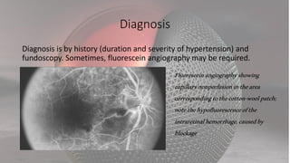 Diagnosis
Diagnosis is by history (duration and severity of hypertension) and
fundoscopy. Sometimes, fluorescein angiography may be required.
Fluoresceinangiographyshowing
capillarynonperfusioninthearea
correspondingtothecotton-woolpatch;
notethehypofluorescenceofthe
intraretinalhemorrhage,causedby
blockage
 