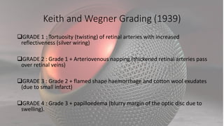 Keith and Wegner Grading (1939)
GRADE 1 : Tortuosity (twisting) of retinal arteries with increased
reflectiveness (silver wiring)
GRADE 2 : Grade 1 + Arteriovenous napping (thickened retinal arteries pass
over retinal veins)
GRADE 3 : Grade 2 + flamed shape haemorrhage and cotton wool exudates
(due to small infarct)
GRADE 4 : Grade 3 + papilloedema (blurry margin of the optic disc due to
swelling).
 