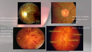 GRADE1:Tortuosityofretinal
arteriesandsilverwiring
GRADE2:G1+AVnipping
(arrow–arterycrossover
ontovein)
GRADE3:G2+flame-
shapedhaemorrhage
andcottonwool
exudate(whitish)
GRADE4:G3+papilloedema
 