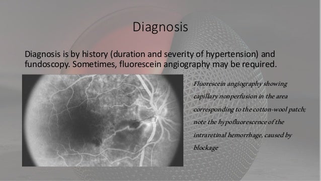 Hypertensive retinopat...