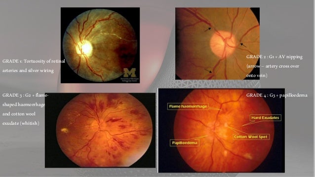 hypertensive retinopathy