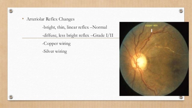 Hypertensive retinopathy