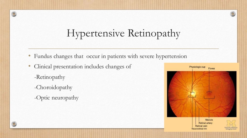 Hypertensive retinopathy