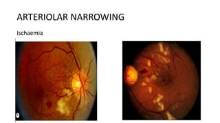 ARTERIOLAR NARROWING
Ischaemia
 