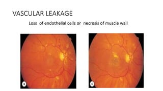 VASCULAR LEAKAGE
Loss of endothelial cells or necrosis of muscle wall
 