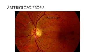 ARTERIOLOSCLEROSIS
Gunn’s sign
 