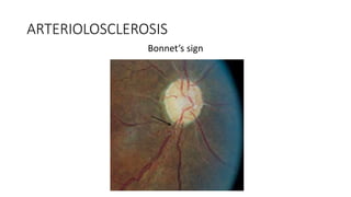 ARTERIOLOSCLEROSIS
Bonnet’s sign
 