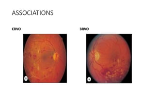 ASSOCIATIONS
CRVO BRVO
 