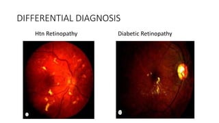 DIFFERENTIAL DIAGNOSIS
Htn Retinopathy Diabetic Retinopathy
 