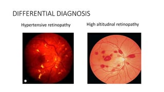 DIFFERENTIAL DIAGNOSIS
Hypertensive retinopathy High altitudnal retinopathy
 