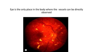 Ocular manifestations
Eye is the only place in the body where the vessels can be directly
observed
 