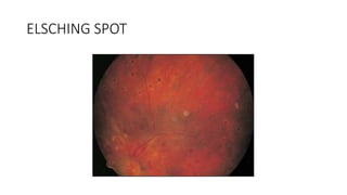 ELSCHING SPOT
 