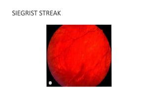 SIEGRIST STREAK
 