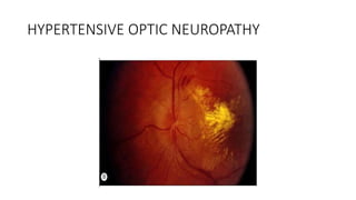 HYPERTENSIVE OPTIC NEUROPATHY
 