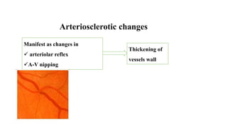 Arteriosclerotic changes
Manifest as changes in
 arteriolar reflex
A-V nipping
Thickening of
vessels wall
 