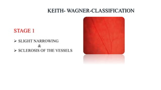 STAGE 1
 SLIGHT NARROWING
&
 SCLEROSIS OF THE VESSELS
 