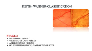 STAGE 2
 MARKED SCLEROSIS
 WIDENING OF LIGHT REFLEX
 ARTERIOVENOUS NICKING
 GENERALIZED OR FOCAL NARROWING OR BOTH
 