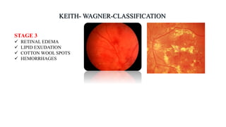 STAGE 3
 RETINAL EDEMA
 LIPID EXUDATION
 COTTON WOOL SPOTS
 HEMORRHAGES
 