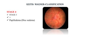 STAGE 4
 STAGE 3
 +
 Papilledema (Disc oedema)
 