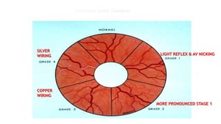 (Arteriosclerotic Changes)
SILVER
WIRING
COPPER
WIRING
LIGHT REFLEX & AV NICKING
MORE PRONOUNCED STAGE 1
 