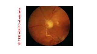 SILVER
WIRING
of
arterioles
 