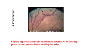 Chronic hypertension stiffens and thickens arteries. At AV crossing
points (arrow) arteries indent and displace veins.
A
V
NICKING
 