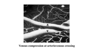 Venous compression at arteriovenous crossing
 