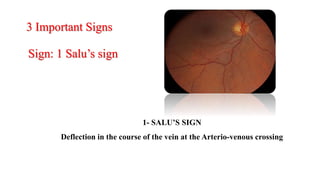 1- SALU’S SIGN
Deflection in the course of the vein at the Arterio-venous crossing
3 Important Signs
Sign: 1 Salu’s sign
 