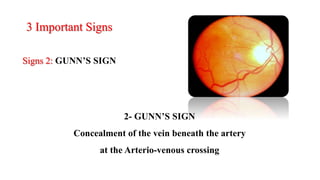 3 Important Signs
Signs 2: GUNN’S SIGN
2- GUNN’S SIGN
Concealment of the vein beneath the artery
at the Arterio-venous crossing
 