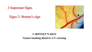 3- BONNET’S SIGN
Venous banking distal to A-V crossing
3 Important Signs
Signs 3: Bonnet’s sign
 