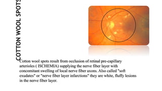 COTTON
WOOL
SPOT
Cotton wool spots result from occlusion of retinal pre-capillary
arterioles ( ISCHEMIA) supplying the nerve fiber layer with
concomitant swelling of local nerve fiber axons. Also called "soft
exudates" or "nerve fiber layer infarctions" they are white, fluffy lesions
in the nerve fiber layer.
 