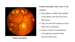 Cotton wool spots (other name is soft
exudate)
 They appear as fluffy white patches
on the retina at the tip of the nerve
fiber layers.
 They are caused by damage to nerve
fibers due to ischaemia
 and are a result of accumulations
of axoplasmic material within
the nerve fiber layer.
Cotton wool spots
 