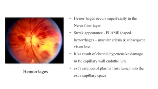 • Hemorrhages occurs superficially in the
Nerve fiber layer
• Streak appearance - FLAME shaped
hemorrhages – macular edema & subsequent
vision loss
• It’s a result of chronic hypertensive damage
to the capillary wall endothelium
• extravasation of plasma from lumen into the
extra capillary space
Hemorrhages
 