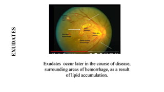 EXUDATES
Exudates occur later in the course of disease,
surrounding areas of hemorrhage, as a result
of lipid accumulation.
 