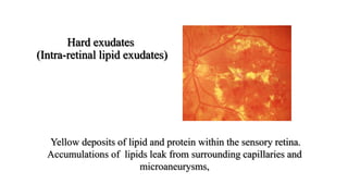 Hard exudates
(Intra-retinal lipid exudates)
Yellow deposits of lipid and protein within the sensory retina.
Accumulations of lipids leak from surrounding capillaries and
microaneurysms,
 