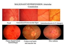 MALIGNANT HYPERTENSION: Arteriolar
Constriction
Focal Generalized Extravascular Signs Arteriolosclerosis (A-V changes)
Flame-shaped retinal
haemorrhages
Cotton-wool spots
and macular star
Disc oedema
 