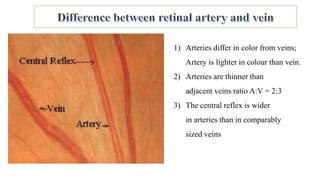 1) Arteries differ in color from veins;
Artery is lighter in colour than vein.
2) Arteries are thinner than
adjacent veins ratio A:V = 2:3
3) The central reflex is wider
in arteries than in comparably
sized veins
 