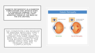 Hypertensive retinopathy | PPTX
