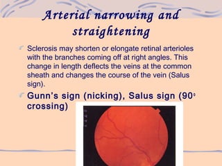 Arterial narrowing and
straightening
Sclerosis may shorten or elongate retinal arterioles
with the branches coming off at right angles. This
change in length deflects the veins at the common
sheath and changes the course of the vein (Salus
sign).
Gunn’s sign (nicking), Salus sign (90o
crossing)
 