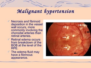Malignant hypertension
Necrosis and fibrinoid
deposition in the vessel
wall occurs, more
commonly involving the
choroidal arteries than
retinal arteries.
Retinal edema occurs
from breakdown of the
BOB at the level of the
RPE.
The edema fluid may
have a fibrinous
appearance.
 