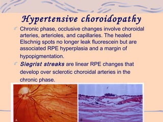 Hypertensive choroidopathy
Chronic phase, occlusive changes involve choroidal
arteries, arterioles, and capillaries. The healed
Elschnig spots no longer leak fluorescein but are
associated RPE hyperplasia and a margin of
hypopigmentation.
Siegrist streaks are linear RPE changes that
develop over sclerotic choroidal arteries in the
chronic phase.
 